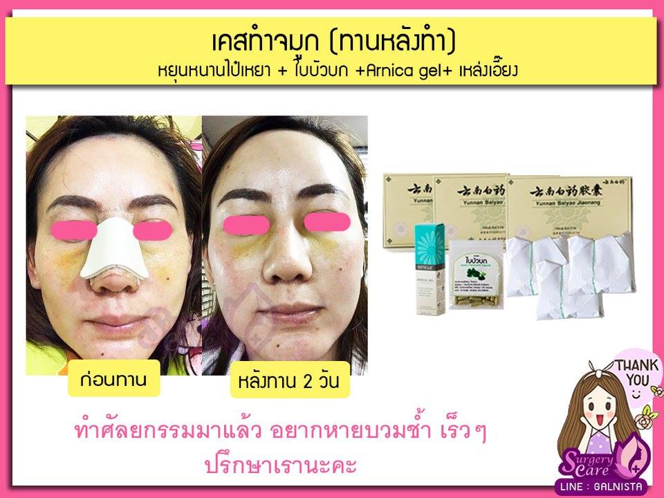เคสทานหลังทำ,รีวิวทำจมูก,รีวิวแก้จมูก,รีวิวเสริมจมูก บวมช้ำน้อย,หายไว,เหล่งเอี้ยง,เหล่งเอี้ยงextra ,สมุนไพรจีน,ยาลดบวมช้ำศัลยกรรม, ลดปวด, ลดอักเสบ, สมานแผล, ทำศัยกรรมอยากหายไว, เหล่งเอี้ยงของแท้, เหล่งเอี้ยง, เหล่งเอี้ยงextra, แผลหายไว, พักฟื้นน้อย, เขียวช้ำ, ลดบวมซ้ำ,ฟื้นตัวไว, หายไว, ยาลดบวม, หยุนหนานไป๋เหยา, หยุนหนานไป๋เหยากล่องเขียว, Yunnanpaiyao,สมุนไพรจีน, ยาลดบวมช้ำศัลยกรรม, ทำศัยกรรมอยากหายไว, หยุนหนานไป๋หยาของแท้, Surgerycare,