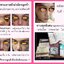 รีวิวทานหลังผ่าศัลยกรรม ผ่ามาแล้วบวมเขียวช้ำหายไว